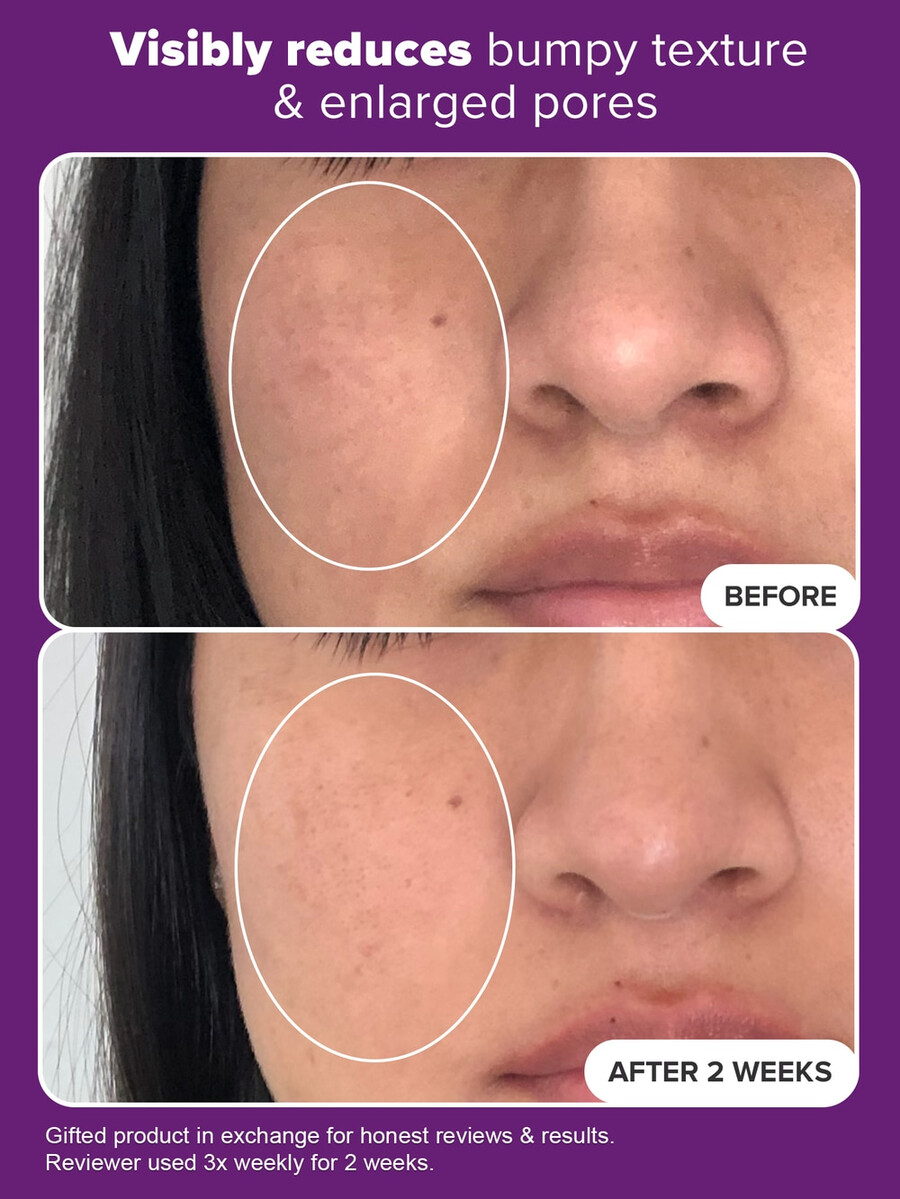 sérum de niacinamide à 20 traitement clinique